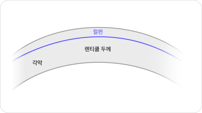 각막절편사진(절편, 각막, 렌티큘 두께)