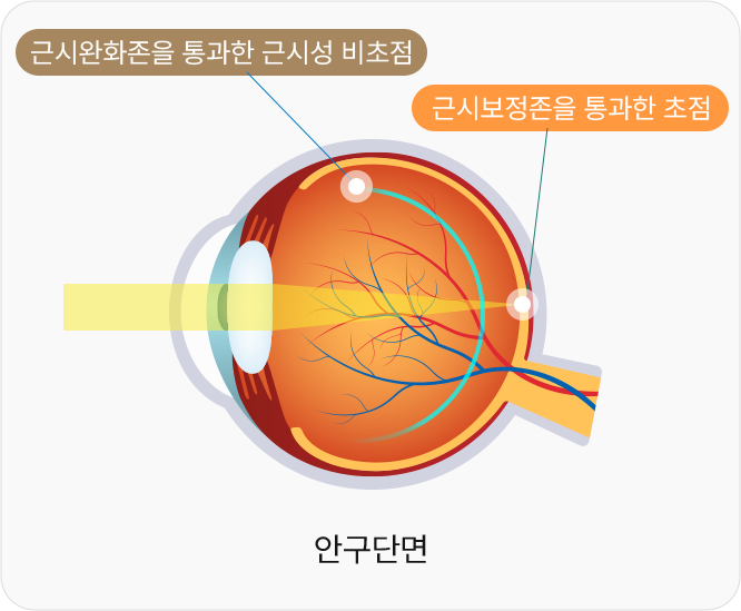 안구단면 - 근시완화존을 통과한 근시성 비초점 , 근시보정존을 통과한 초점  