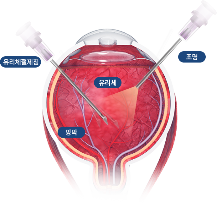 유리체절제침, 조명, 유리체, 망막